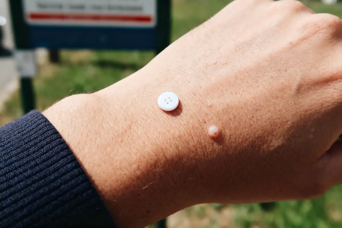 Bouton blanc : Comment les identifier et s’en délester ?