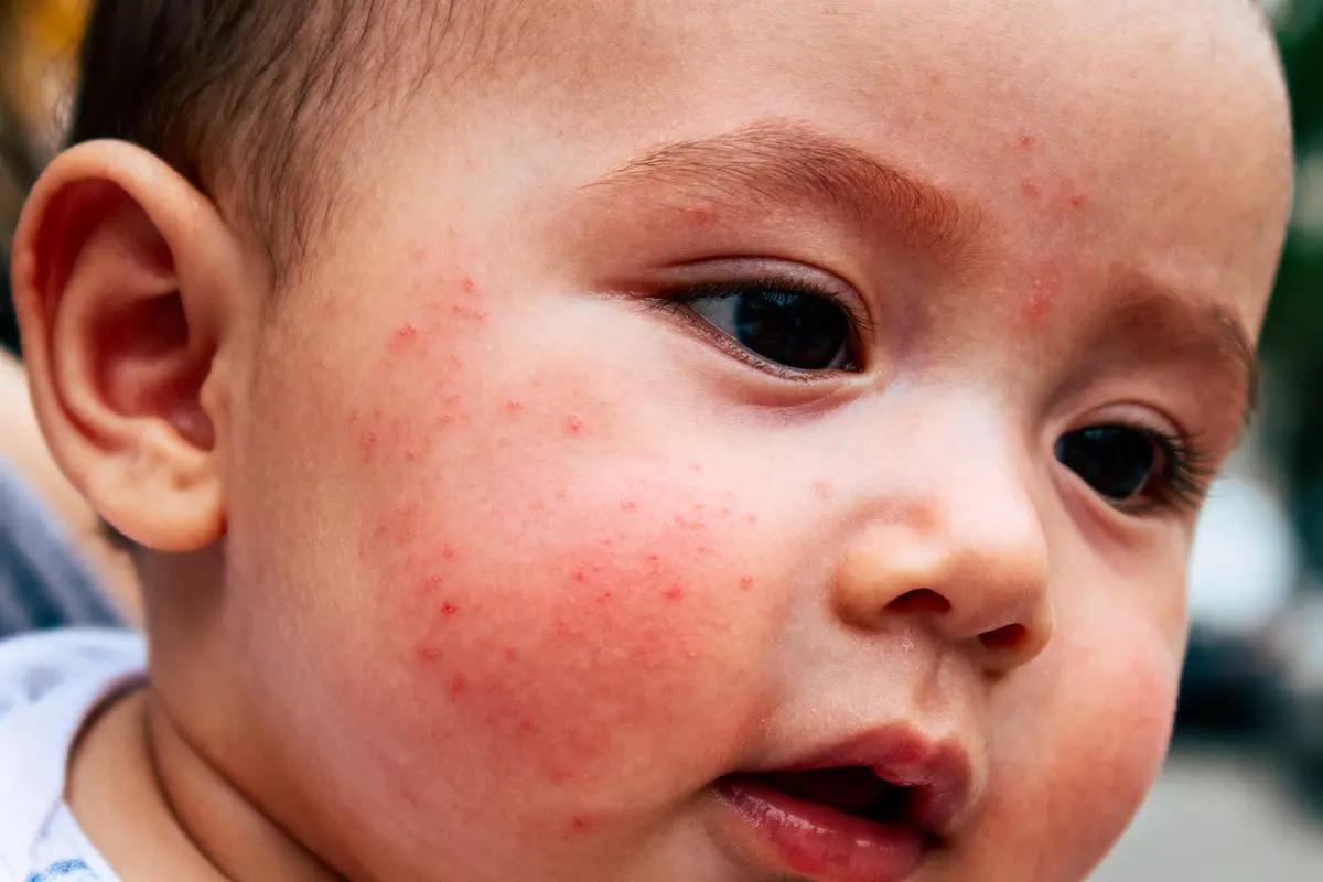 Bébé avec éruption cutanée sur les joues, présentant des rougeurs et petites pustules rouges.