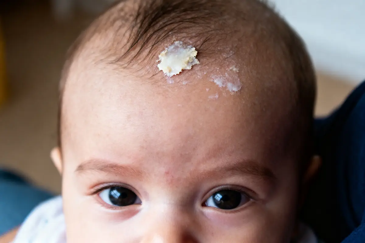 Croûte de lait du bébé : Comment les prévenir et traiter ?