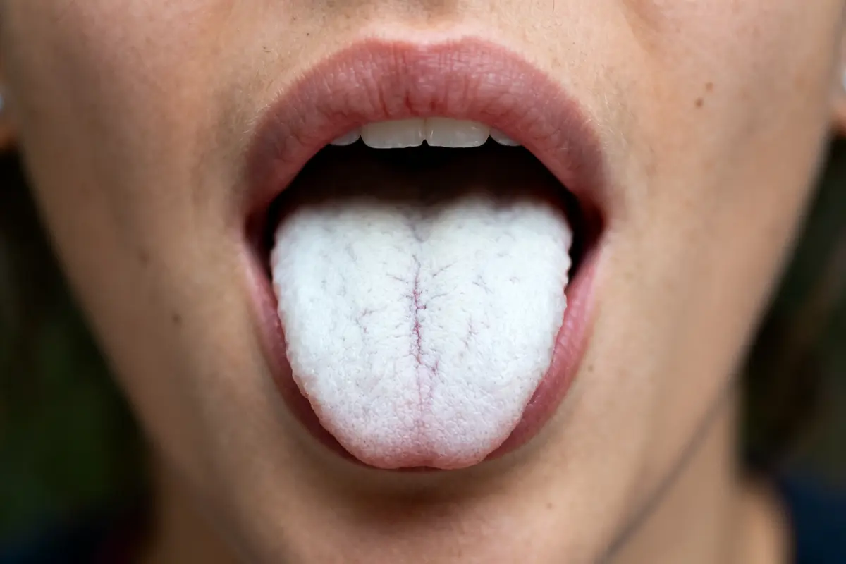 Langue blanche et mal de gorge : causes, symptômes et traitement ?